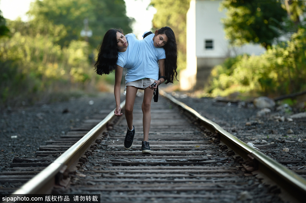 美國16歲連體姐妹拒做分離手術 她們的決定讓人無法理解